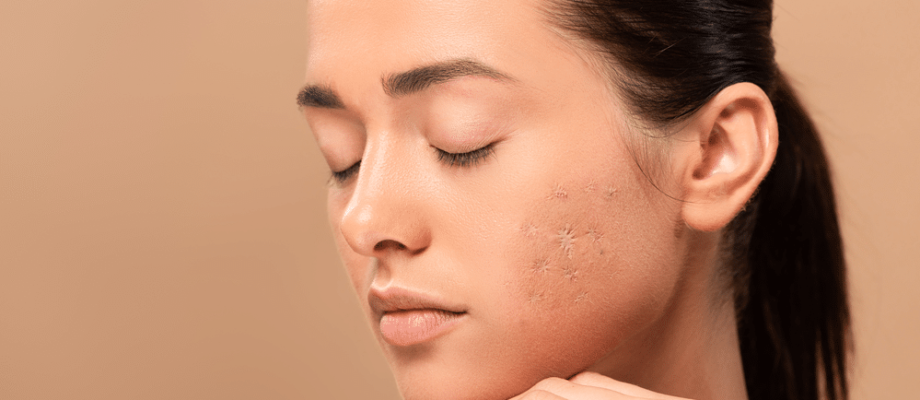 Acne Scar Removal Singapore: Can the Scars be Completely Gone?