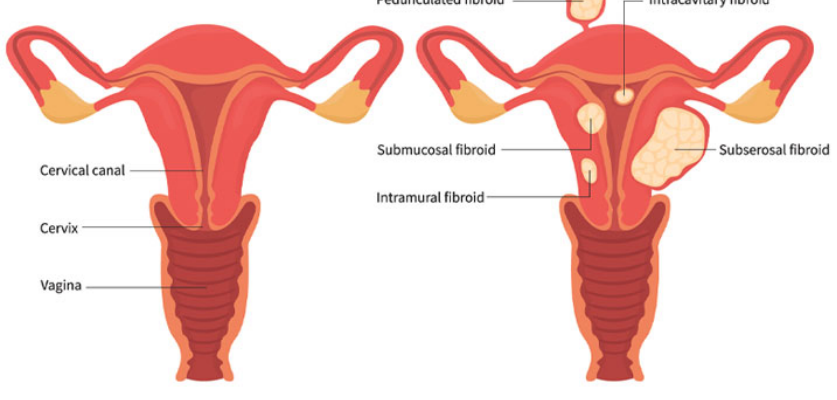 Uterine Fibroids in Singapore: Types, Symptoms, Diagnosis and More